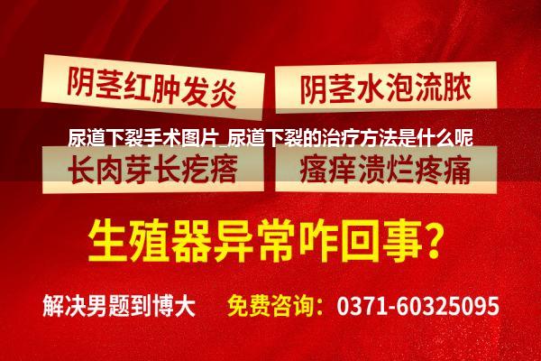 尿道下裂手术图片_尿道下裂的治疗方法是什么呢